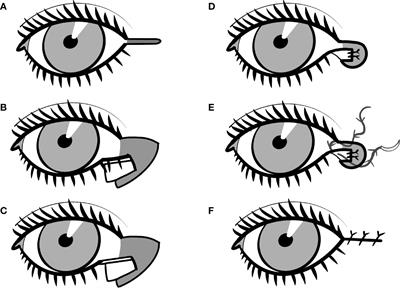 The role of the lateral tarsal strip procedure in modern ophthalmic plastic surgery—A review